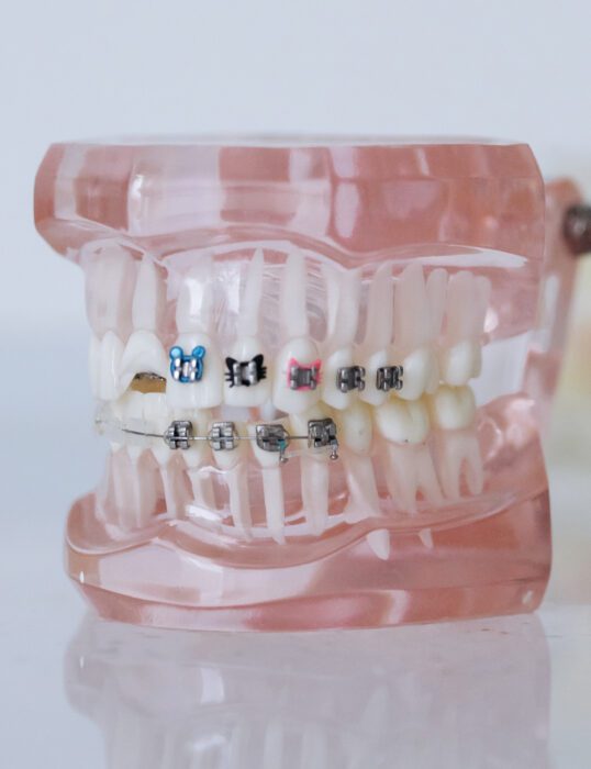A model of a set of teeth, with braces fitted.