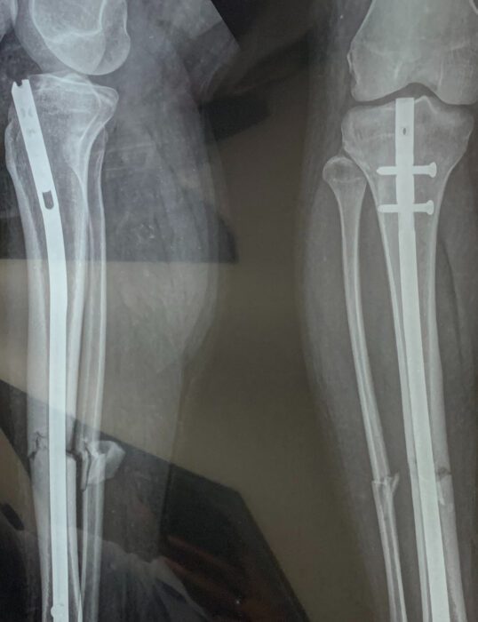 An x-ray of a person's legs, showing reconstructive rods and screws.
